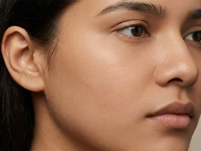 Before using Jamal Emporium skincare — skin with acne, dark spots and uneven tone