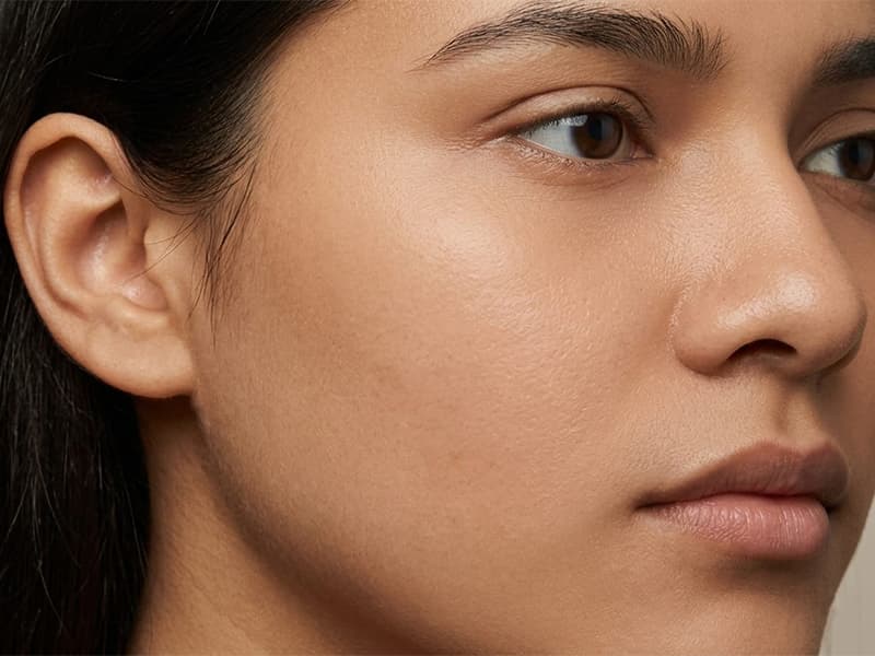 Before using Jamal Emporium skincare — skin with acne, dark spots and uneven tone